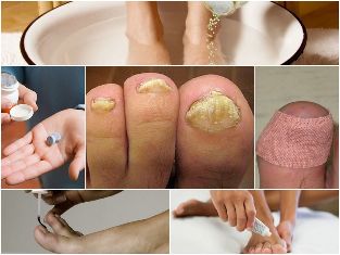 athlete's foot treatment